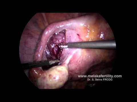 Miomektomi laparoskopi untuk mioma rahim