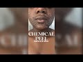 Watch my skin transform in 7 days with my first chemical peel!