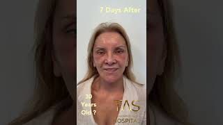 Facelift by Dr.TAS for a 74years old lady
