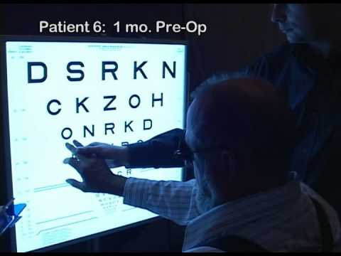 Optobionics - Retinitis Pigmentosa, ASR Implantation 3