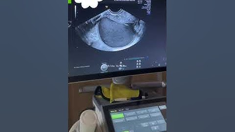 U lạc nội mạc buồng trứng!