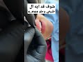روعة ايماكس الاسنان   