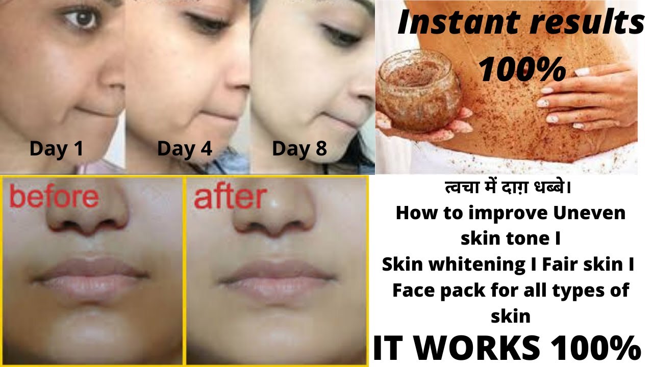 त्वचा में दाग़ धब्बे। How to improve Uneven skin tone