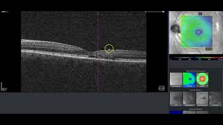 Retina HotMic 03