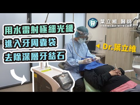 【實境】利用水雷射極細光纖進入牙周囊袋去除深層牙結石。