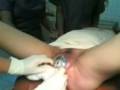 end stage of labor