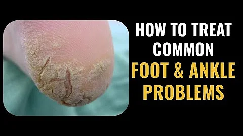 How to TREAT Common Foot and Ankle Problems (COMPL...