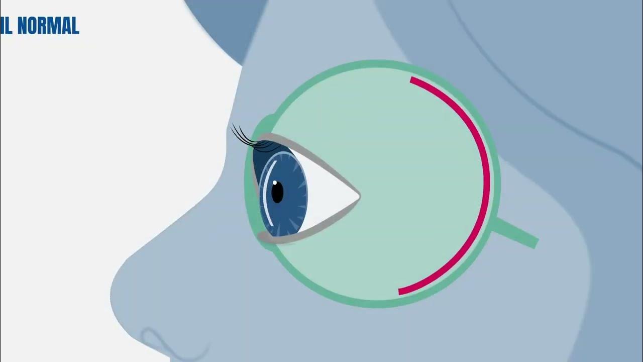 Lentilles de nuit Comment ça marche ? Precilens YouTube