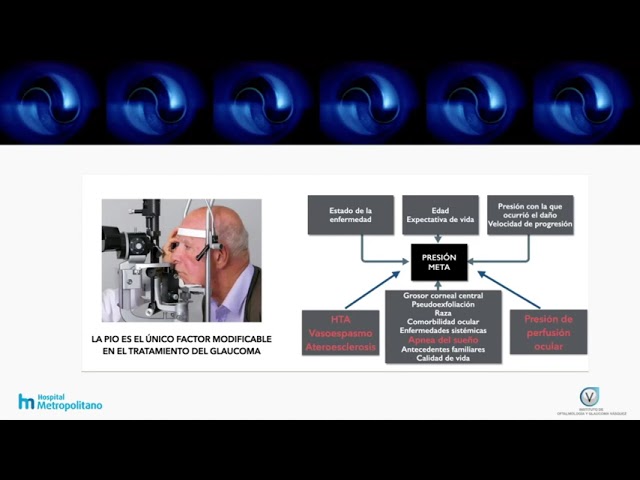 Nuevos Factores de Riesgo en Glaucoma