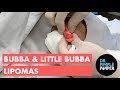 Bubba & Little Bubba Lipomas