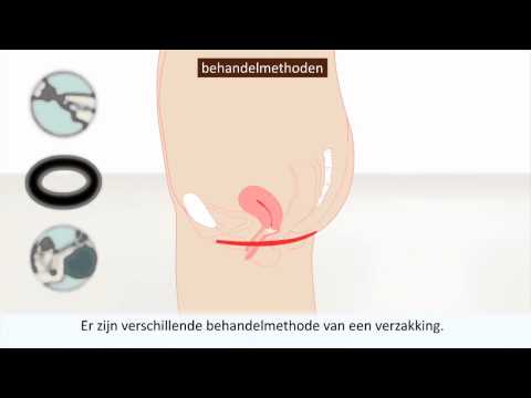 Video: Urethrale Poliep Bij Vrouwen: Foto's, Symptomen, Behandeling, Oorzaken