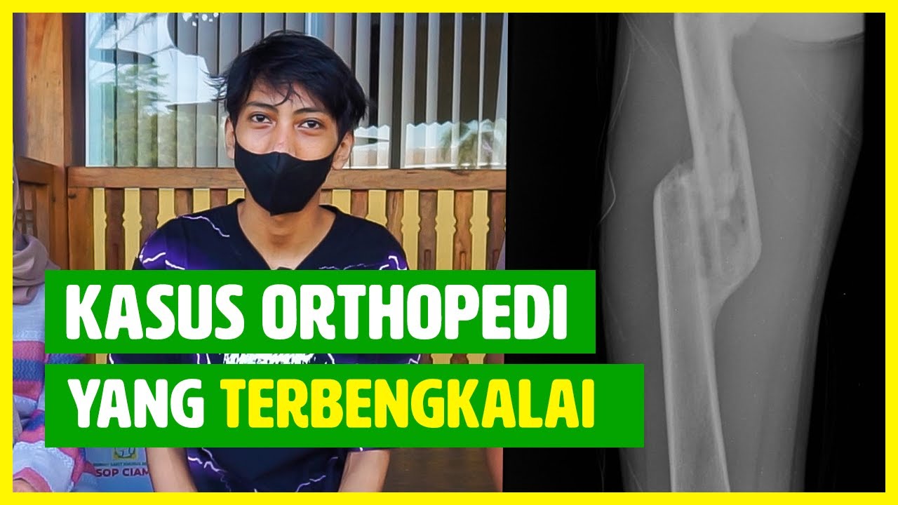 Penanganan Patah Tulang yang Terbengkalai | Neglected Orthopedic Case