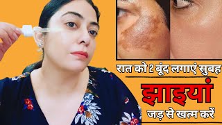 कितनी भी पुरानी झाइयां, काले दाग-धब्बें जड़ से खत्म करो || How to Remove Pigmentation Permanently