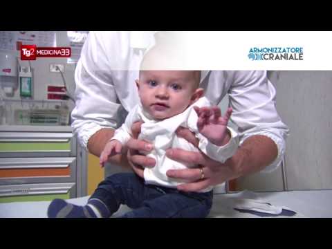 Plagiocefalia: come correggere la testa piatta nei neonati