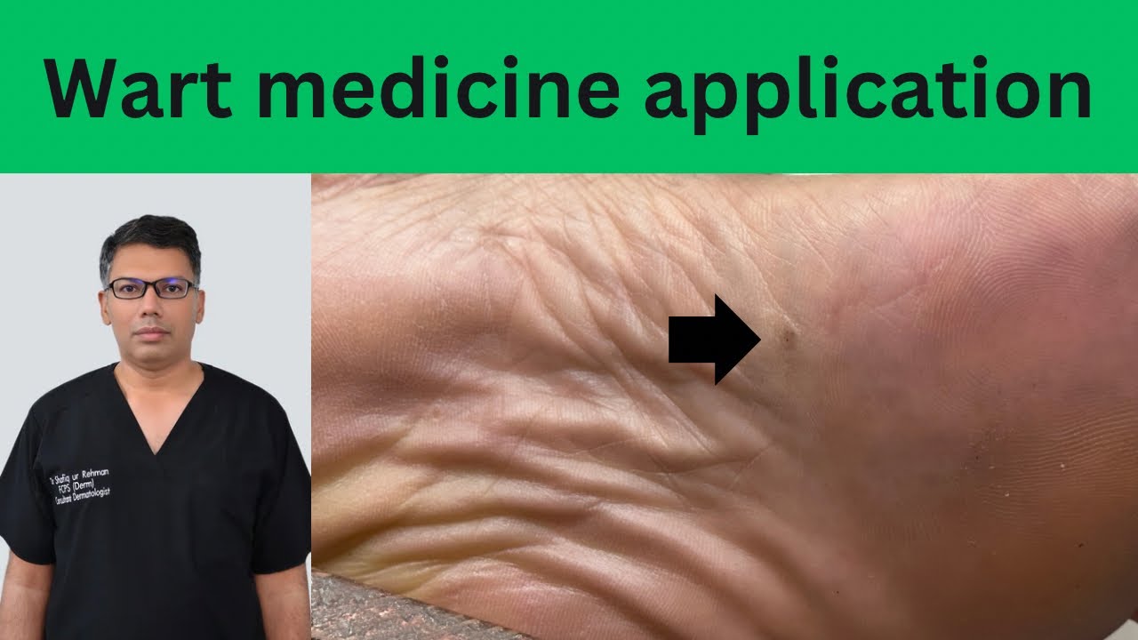 Plantar Wart Medicine Application YouTube Plantar Wart Medicine Application YouTube