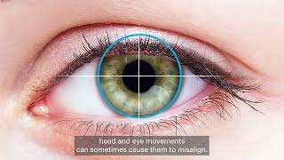 Eyelid Stabilised Design - ACUVUE Contact Lenses for ASTIGMATISM