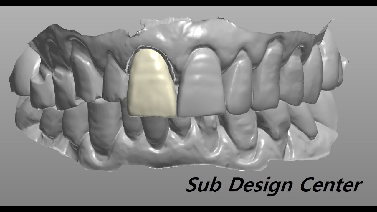 3shape design (anterior teeth 😬) // 전치부 간단한 케이스 디자인 - YouTube