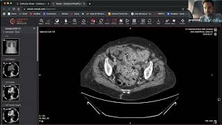 Stercoral Colitis on CT: When Abdominal Pain Isn’t Diverticulitis