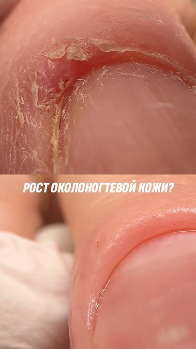 Приостановка роста кутикулы запатентованной «лысой» фрезой # ...