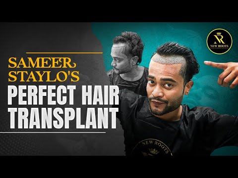 Influencer Sameer Staylo’s Hair Transplant Journey 😍 | New Roots Nagpur