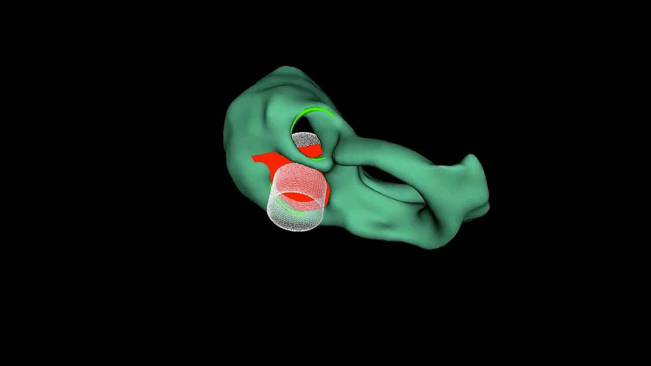 3D Slicer Virtual Melody Device Placement in Mitral Valve Annulus and Heart Model