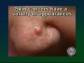 Skin cancer types treatment: melanoma basal cell carcinoma, squamous cell carcinoma