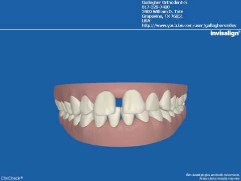 Another Great Patient Treated by Dr. Robert Gallagher