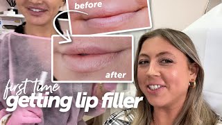 Getting Lip Filler for the FIRST TIME! My experience, Healing process, Before &amp; Afters (+ botox)
