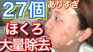 整形 顔のホクロ全部とってみた Youtube