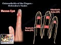 Osteoarthritis of the fingers heberdens nodes   everything you need to know  dr nabil ebraheim