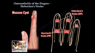 Osteoarthritis Of The Fingers Heberden