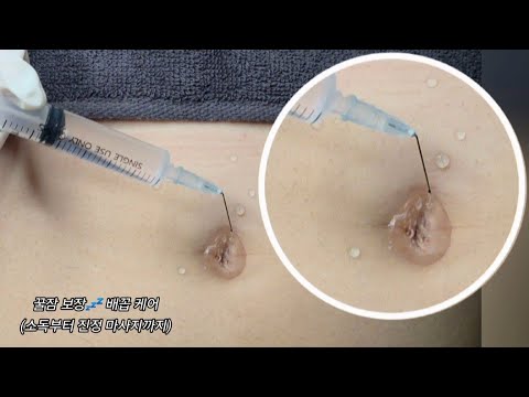 ASMR) Real Series_  Sleep tight!! Belly care_  꿀잠 보장 배꼽 케어(소독부터 진정 마사지까지)  甘い眠り保証!! へそケア!!