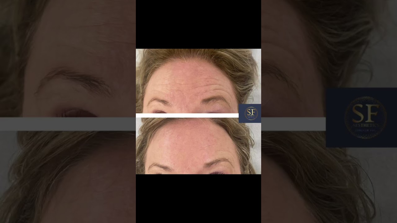 SFAesthetics at KB Therapy Clinic in Northampton 