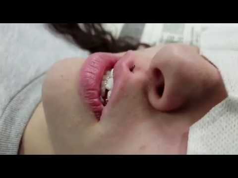 Video: Cómo hacerse un piercing de Medusa (con imágenes)