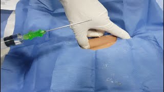 Central venous line procedure (CVL)