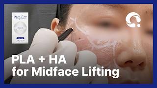 PLA + HA for Midface Lifting - Pla’Vann Volume
