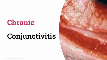 Chronic non-specific conjunctivitis