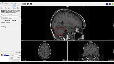 Analyze 15.0 - Segment: Using Walls