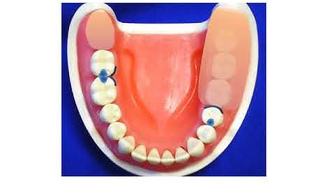 A Kennedy Class II RPD Design Scenario