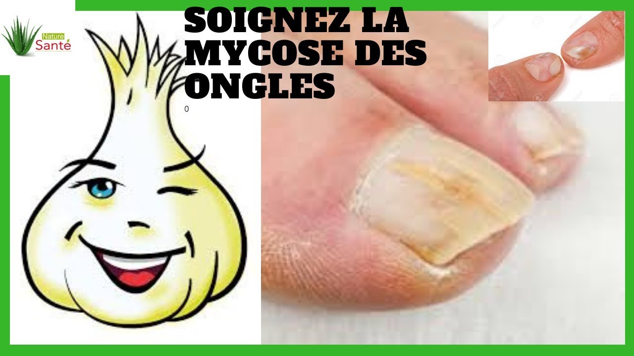 Comment Eliminer Les Champignons Et Renforcer Les Ongles | Mycoses Des