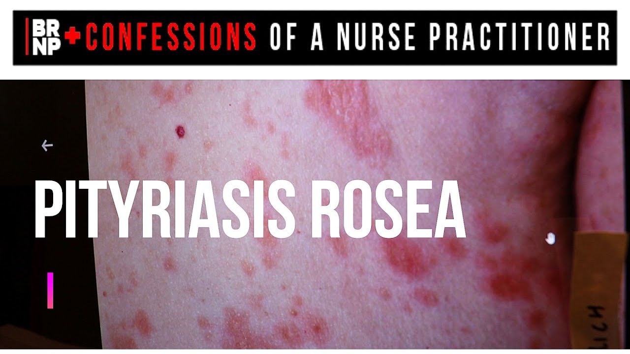 Pityriasis Rosea Youtube