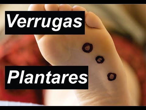 VERRUGAS PLANTARES (PAPILOMA VIRUS) 🦶 LIMA BLUE 🦶 MEDICINA EXTRAORDINARIA