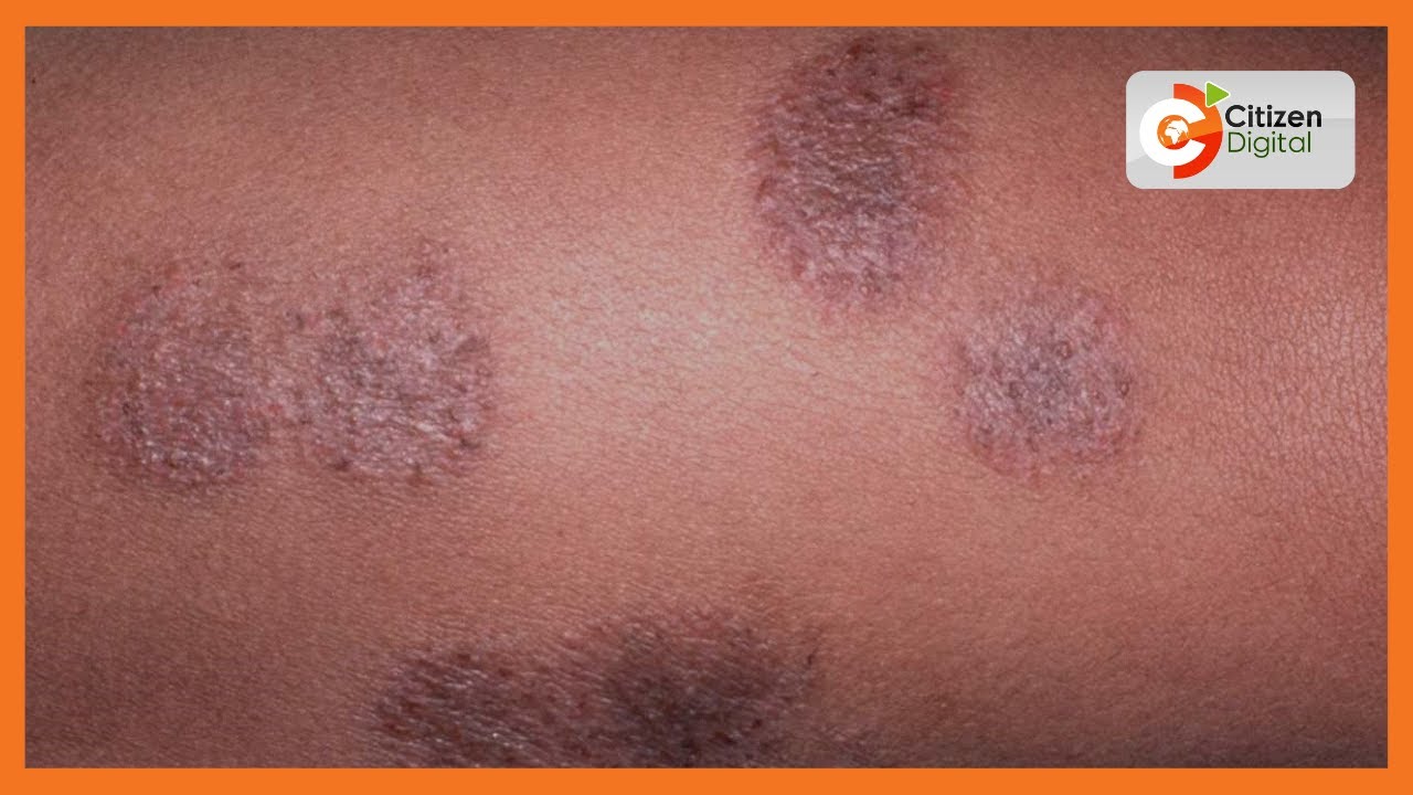 Jukwaa la Afya | Mdahalo kuhusu magonjwa ya ngozi, kinga na tiba (Part 1)