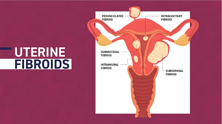 Fibroid Awareness Month | Managing and Treating Uterine Fibroids - DayDayNews