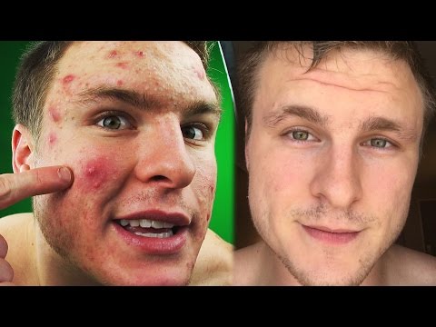 REMOVE REDNESS ACNE & SCARRING! - YouTube