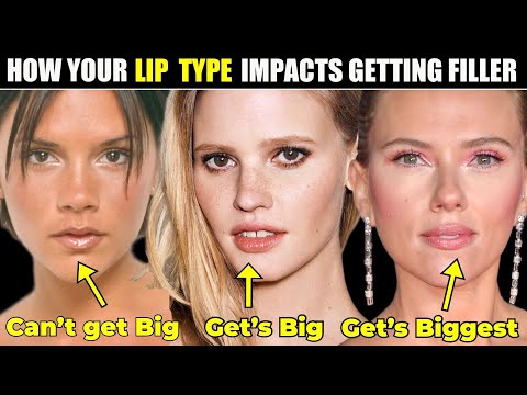 Is your Lip Type a good match for Filler?- How your Lip Type Impacts getting Lip Filler