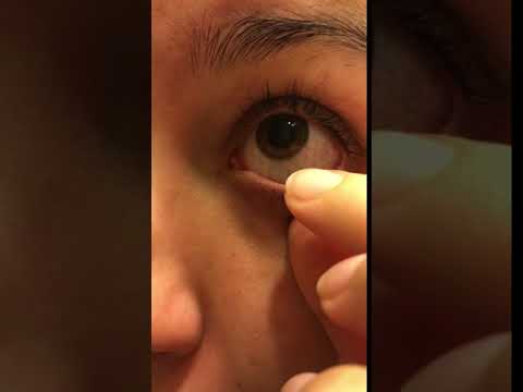 Satisfying Eye String Removal From Eye Allergies