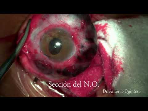 Enucleación: Procedimiento quirúrgico de extracción del globo ocular