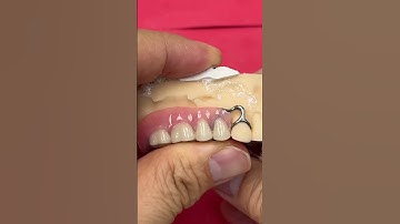 Posterior Titanium Partial @EnvisiontecMain #envisiontec