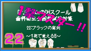 歯科衛生士 国家試験対策 22ブラックの窩洞 Dr デン山のdhスクール 歯科衛生士国家試験対策 Youtube 歯科衛生士 国家試験対策 22ブラックの窩洞 Dr デン山のdhスクール 歯科衛生士国家試験対策 Youtube